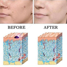 Load image into Gallery viewer, Advanced Skin Spots Removal Pen (Blue Light™ Technology)